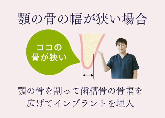 顎の骨の幅が狭い場合 顎の骨を割って歯槽骨の骨幅を広げてインプラントを埋入