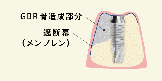 GBR骨造成部分、遮断幕（メンブレン）