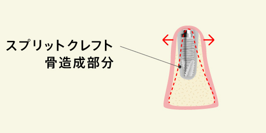 スプリットクレフト骨造成部分