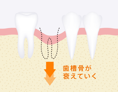 歯槽骨が衰えていく